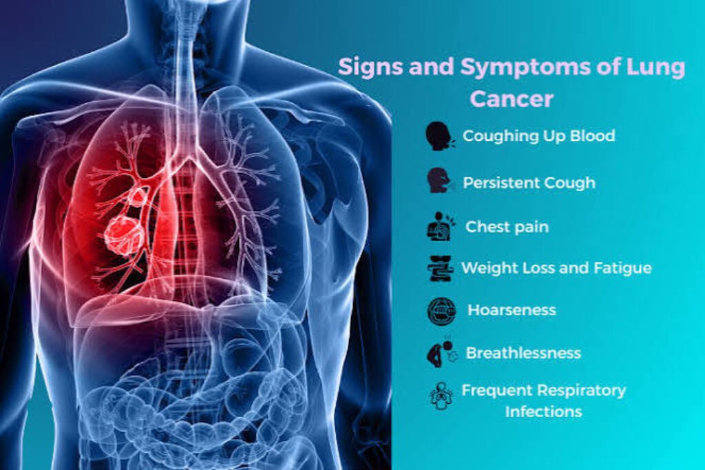 Lung Cancer: Symptoms, Causes, Treatment, and Prevention