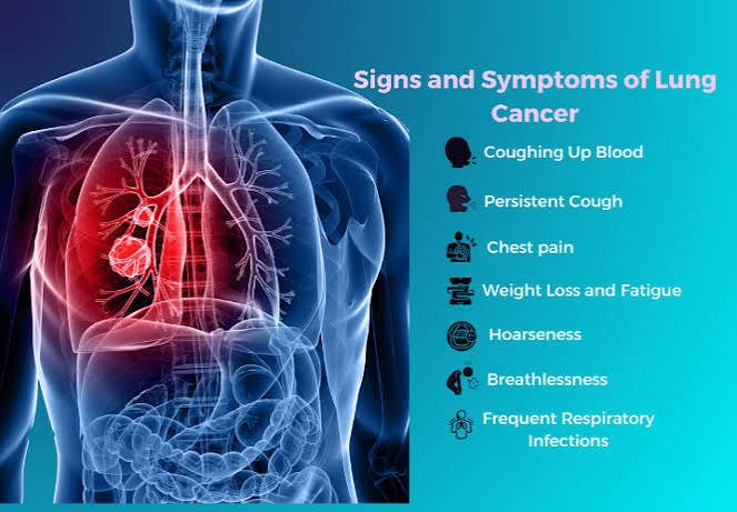 Lung Cancer: Symptoms, Causes, Treatment, and Prevention